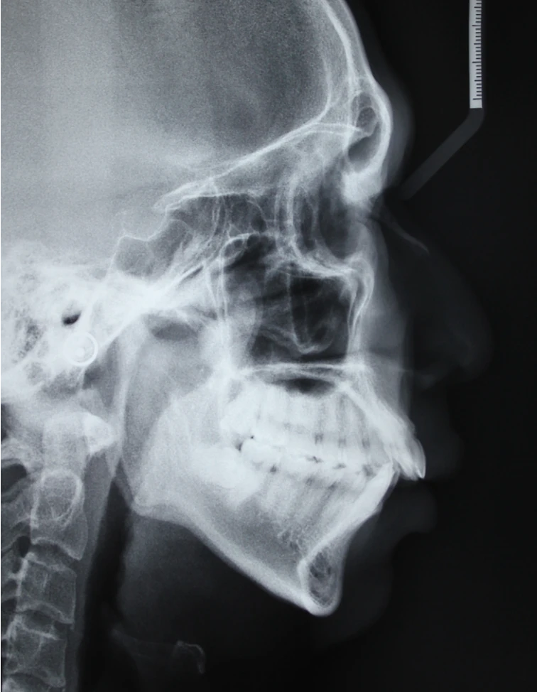 Lateral cephalometric radiograph